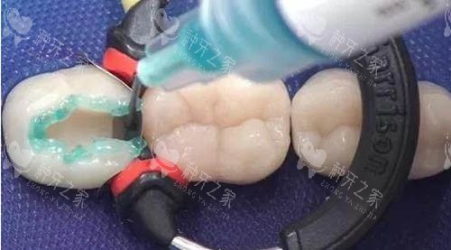 儿童补牙材料 儿童补牙材料