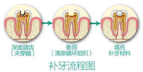 补牙流程图示意图 补牙流程图示意图