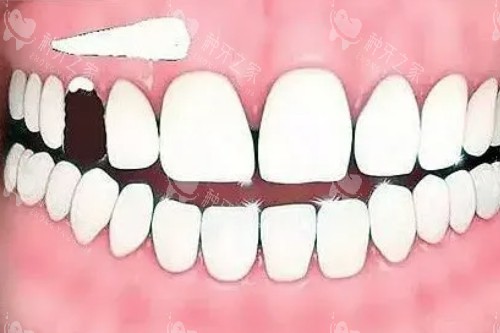 牙齿缺损卡通图 牙齿缺损卡通图