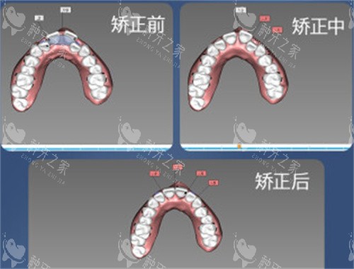 牙齿矫正设计图 牙齿矫正设计图