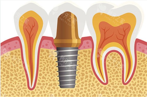武汉牙基地510元种植牙价格优惠技术可靠解析!