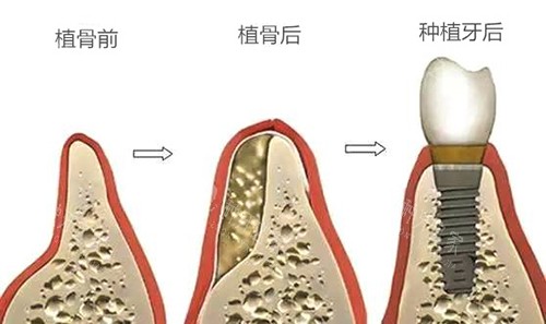 种植牙植骨前后于种植牙后漫画图 种植牙植骨前后于种植牙后漫画图