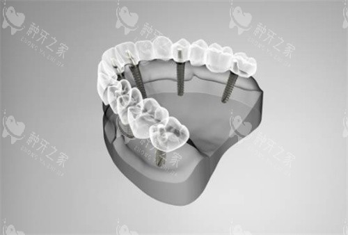 半口种植牙模拟示意图 半口种植牙模拟示意图