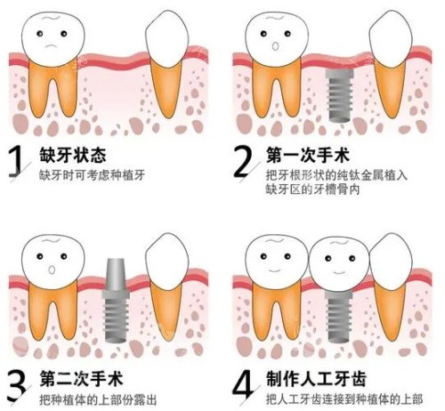 种植牙后的成效 种植牙后的成效