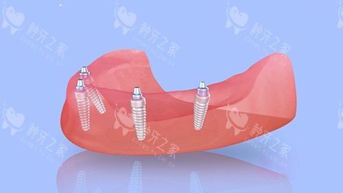 半口种植牙四颗植体植入漫画图 半口种植牙四颗植体植入漫画图
