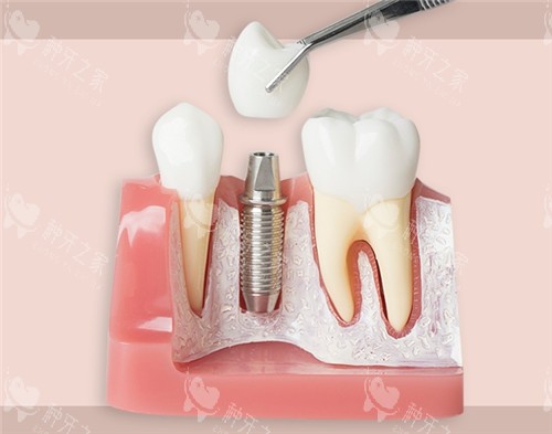 种植牙模具图片 种植牙模具图片