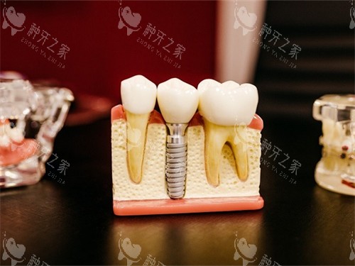 种植牙的牙齿模型展示图 种植牙的牙齿模型展示图