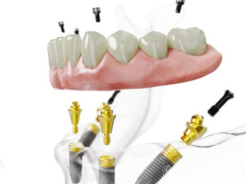 种植牙失败取出植体会留洞吗?亲身经历者揭秘!