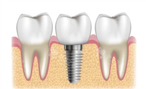 种植牙周围健康牙 种植牙周围健康牙