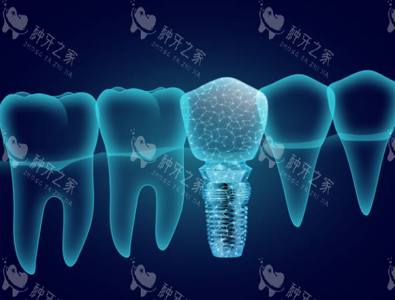 种植牙模型图卡通图 种植牙模型图卡通图