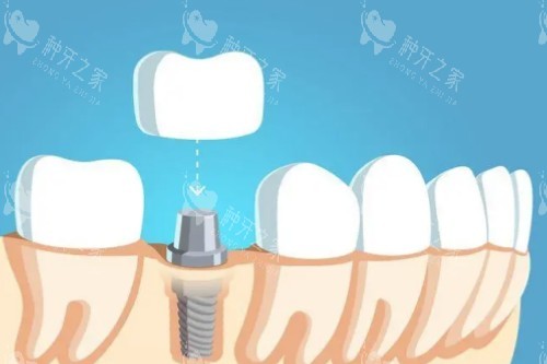 种植牙戴牙冠卡通图 种植牙戴牙冠卡通图