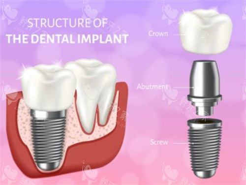 种植牙模拟示意图 种植牙模拟示意图