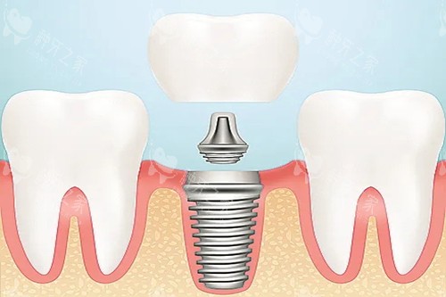 口腔种植牙卡通示意图 口腔种植牙卡通示意图