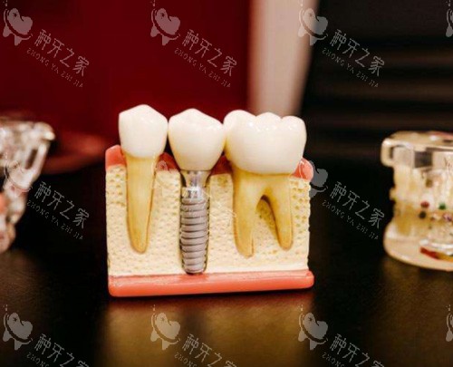 种植牙模具图 种植牙模具图