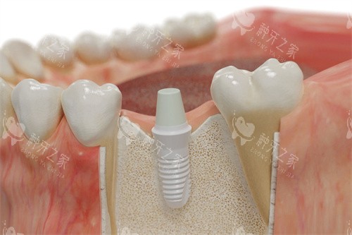 德国SKY种植牙植入模拟图