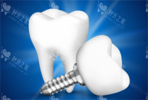 2颗种植牙模型图 2颗种植牙模型图