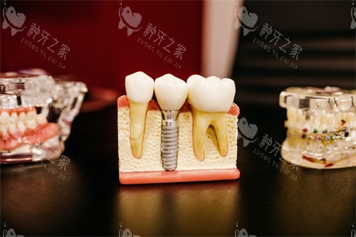 60岁阿姨经历:牙龈萎缩10年,终于敢种牙了!