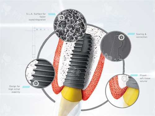 东莞博球口腔医院种植牙怎么样?登腾2000元起!