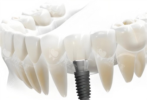 种植牙卡通展示展示图 种植牙卡通展示展示图