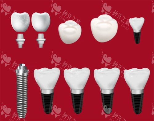 种植牙种植体牙冠 种植牙种植体牙冠