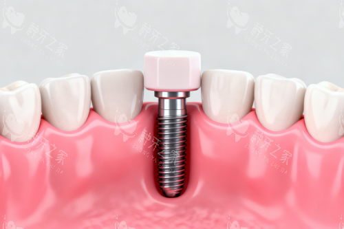 种植牙植入口腔模型图 种植牙植入口腔模型图