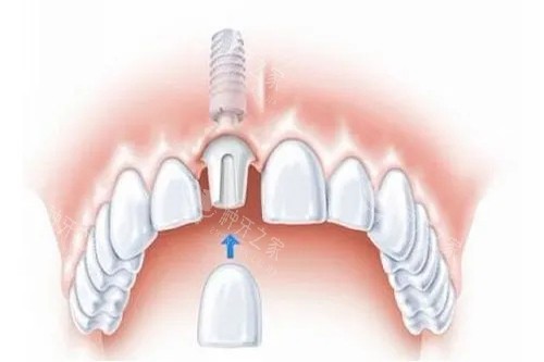 单颗种植牙安装牙冠卡通示意图 单颗种植牙安装牙冠卡通示意图