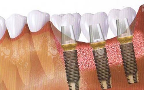 种植牙手术后图 种植牙手术后图