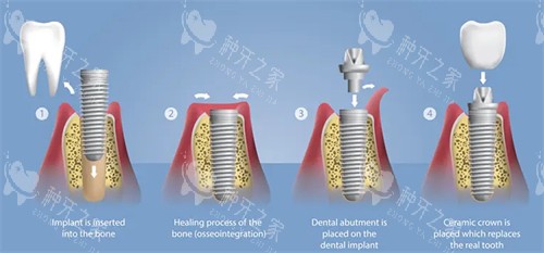 种植牙手术流程图 种植牙手术流程图