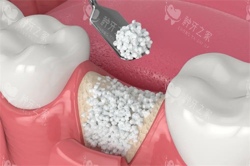 牙槽骨骨粉植入漫画图 牙槽骨骨粉植入漫画图