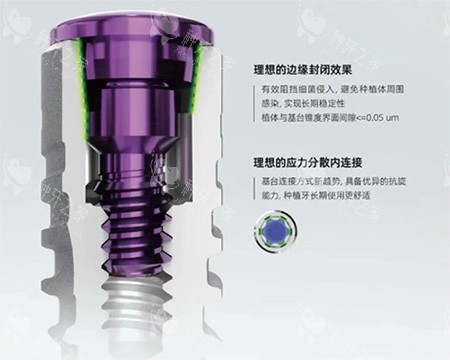 卡尔斯种植牙特色照片 卡尔斯种植牙特色照片