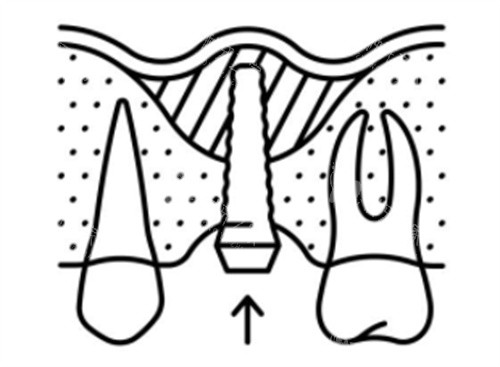 种植牙能管一辈子吗?10年使用者分享3个关键要点