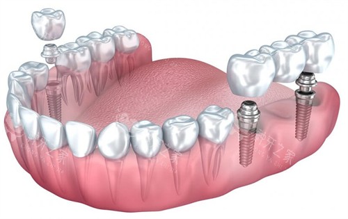 糖尿病患者可以做种植牙吗？控制在这个数就可以种牙