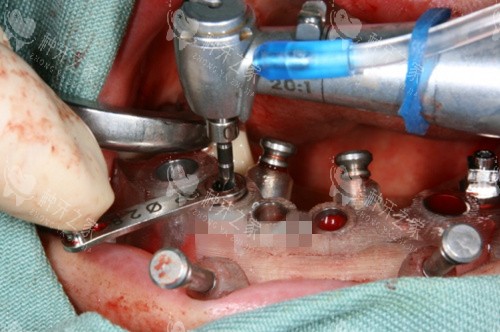 种植牙面诊必问10个问题!牙医不会主动说,必看