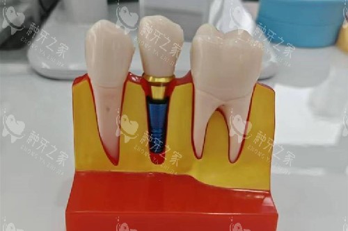 种植牙流程全解析:从CT检查到戴牙冠分几步