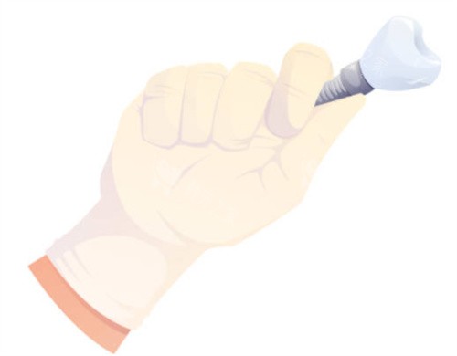手拿种植牙 手拿种植牙