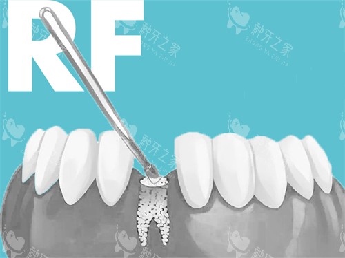 种植牙植骨漫画图