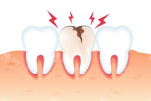 牙齿破裂 牙齿破裂