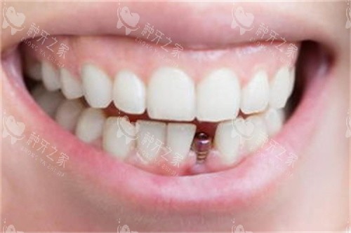 正在做种植的牙齿 正在做种植的牙齿