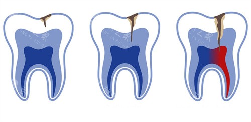 牙釉质牙齿龋坏不同程度
