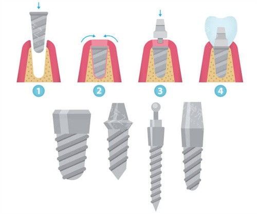 mis种植体进集采了吗?必须进了!种牙超放心!