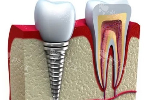 种植牙植入模型图 种植牙植入模型图