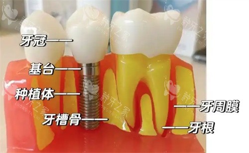 丹特因种植牙是几级钛?高等级钛没跑!