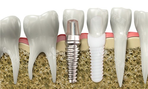担心ab种植牙不持久?非杂牌超25年仍好用