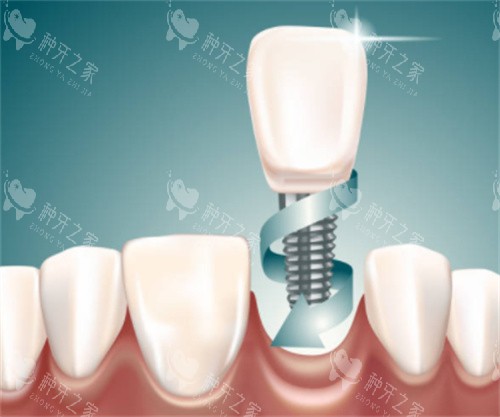 种植牙在口腔图 种植牙在口腔图