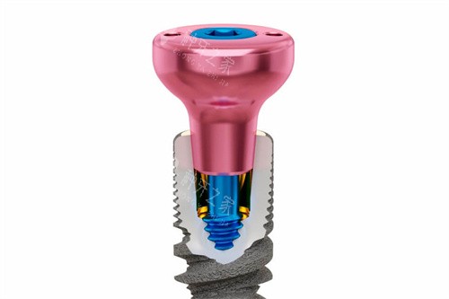 种植牙愈合基台透视图 种植牙愈合基台透视图