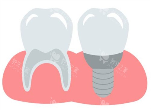 种植牙和牙齿图 种植牙和牙齿图