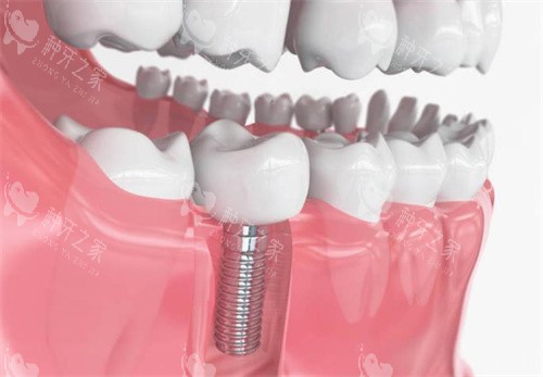 种植牙模型展示图片 种植牙模型展示图片