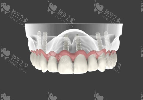 半口种植牙模型图 半口种植牙模型图