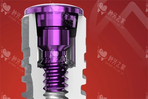 卡尔斯种植牙简介 卡尔斯种植牙简介