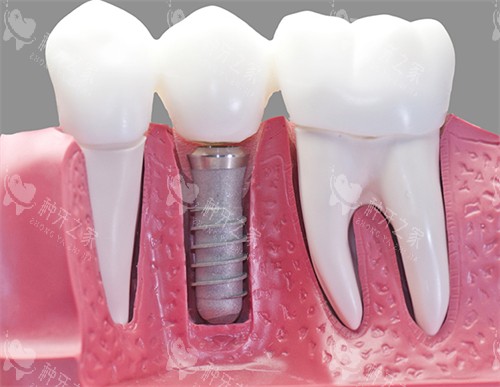 单颗种植牙动画图示 单颗种植牙动画图示
